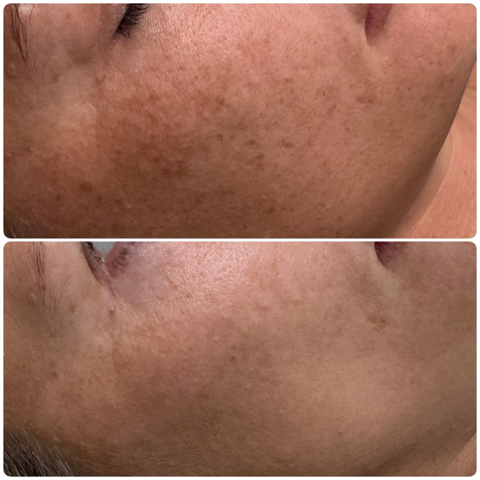 Before and after — pigmentation on the cheek