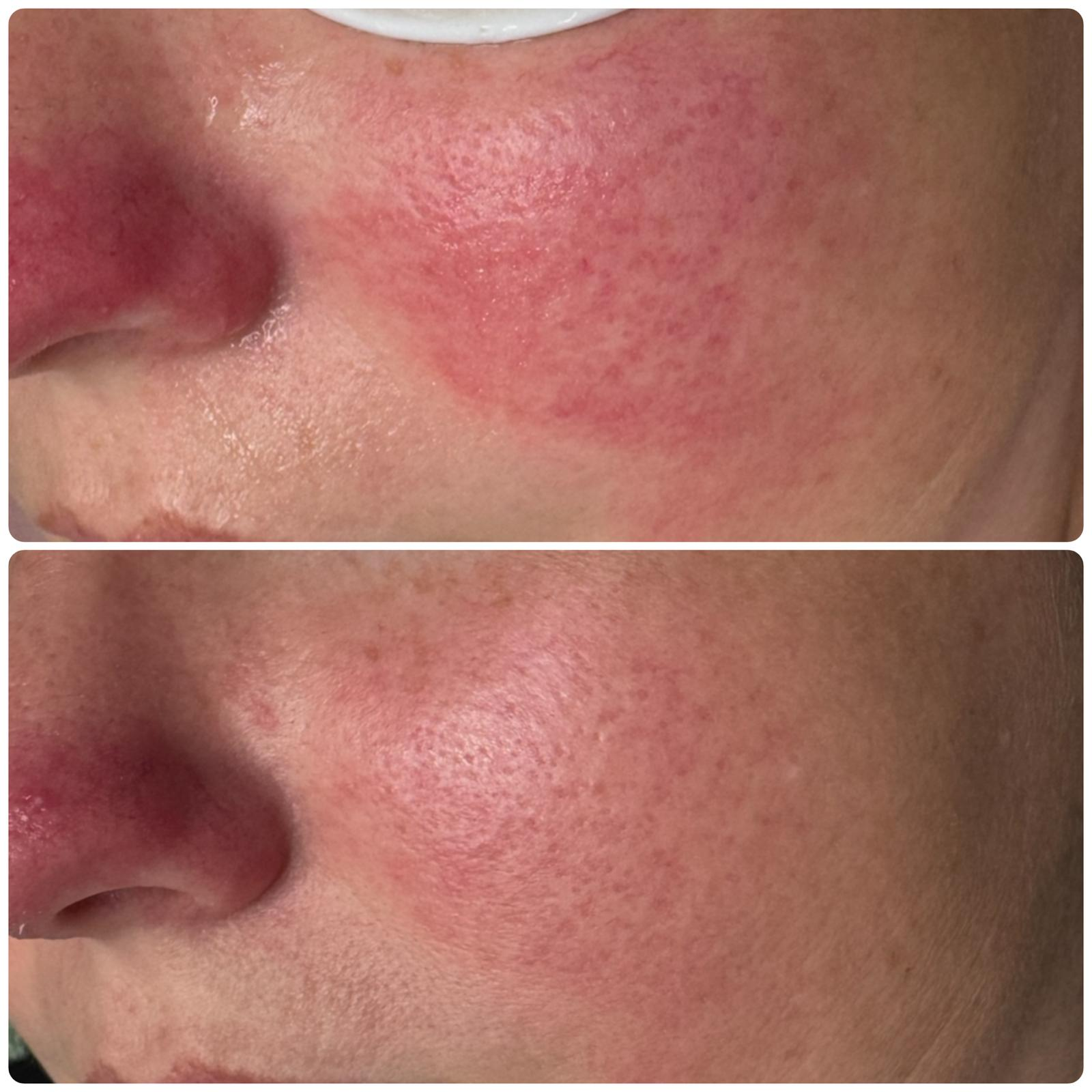 Before and after — rosacea and redness reduction