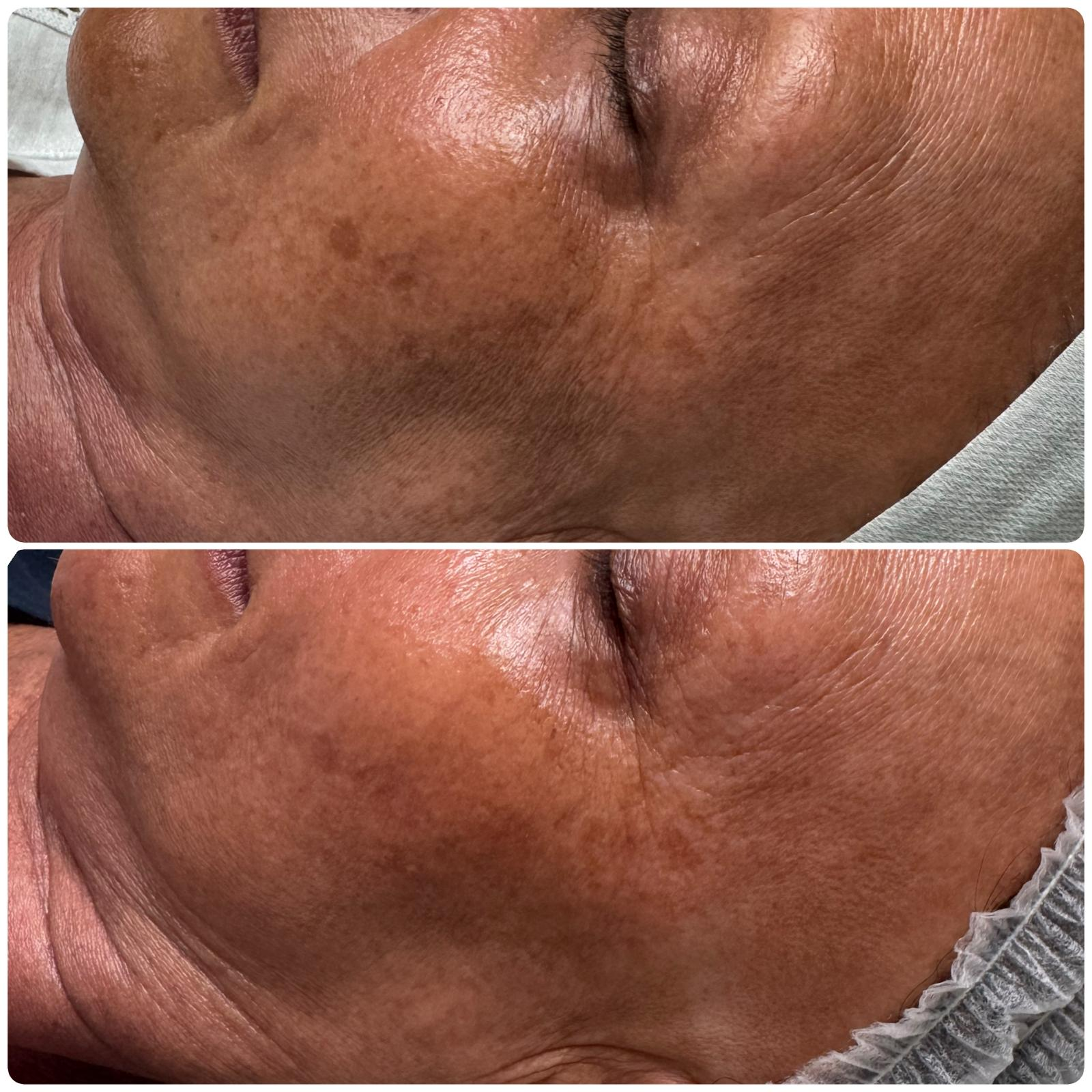 Before and after — sun damage and pigmentation