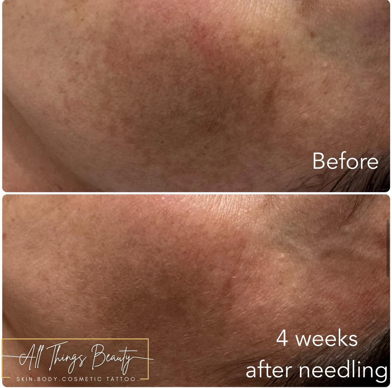 Before and after — 4 weeks after skin needling