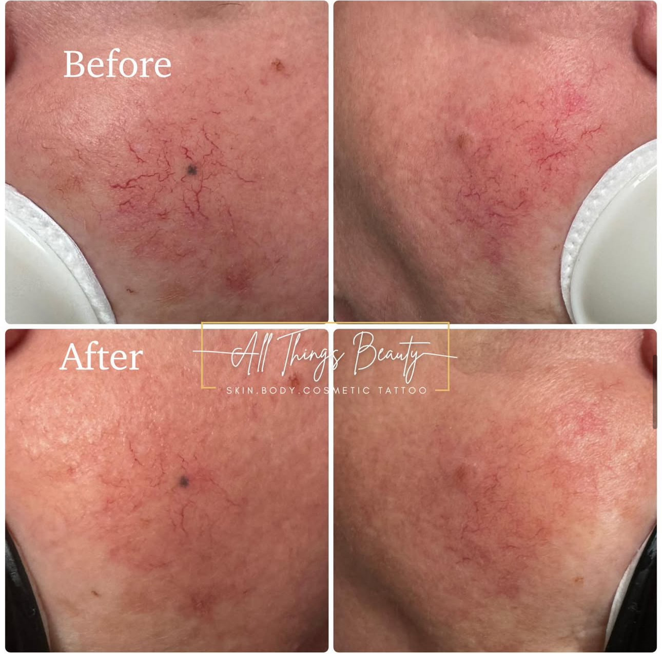 Before and after — facial capillaries and redness