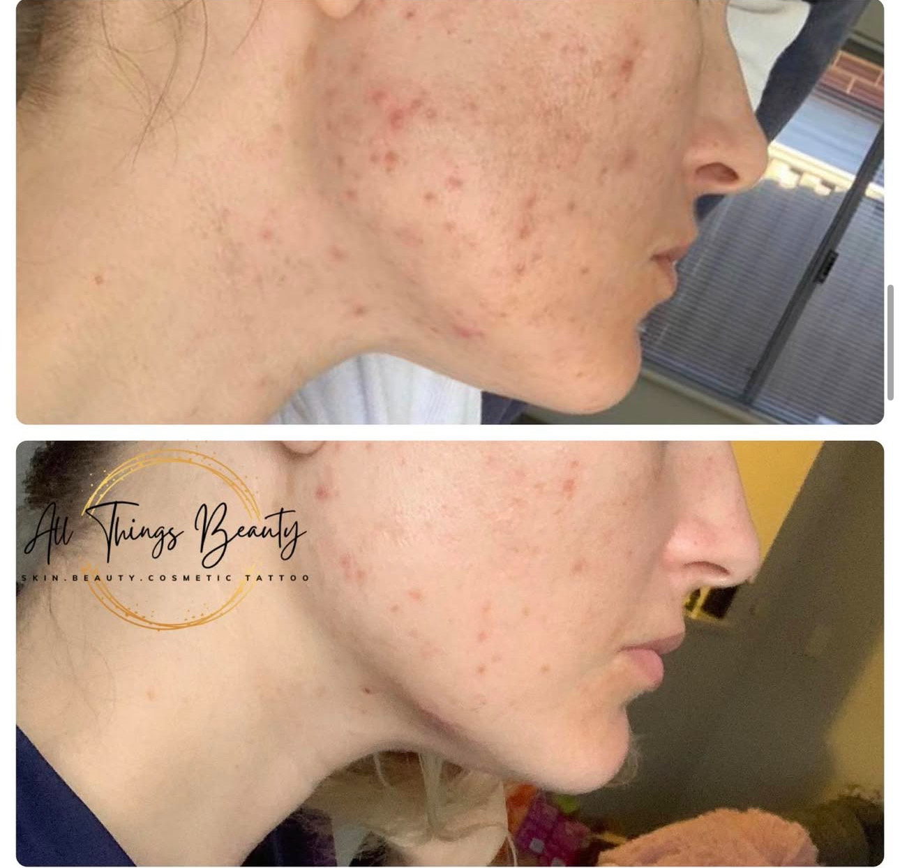 Before and after — acne and congestion clearing